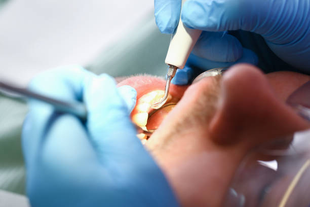 Best Emergency Dental Care for Sports Injuries in Aspen, CO